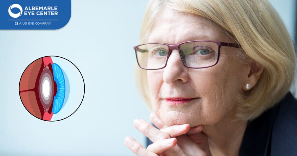 Different Types of Cataracts