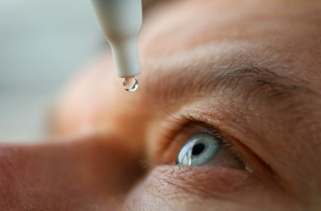 A close up of a person administering eye drops to their eye after cataract surgery.