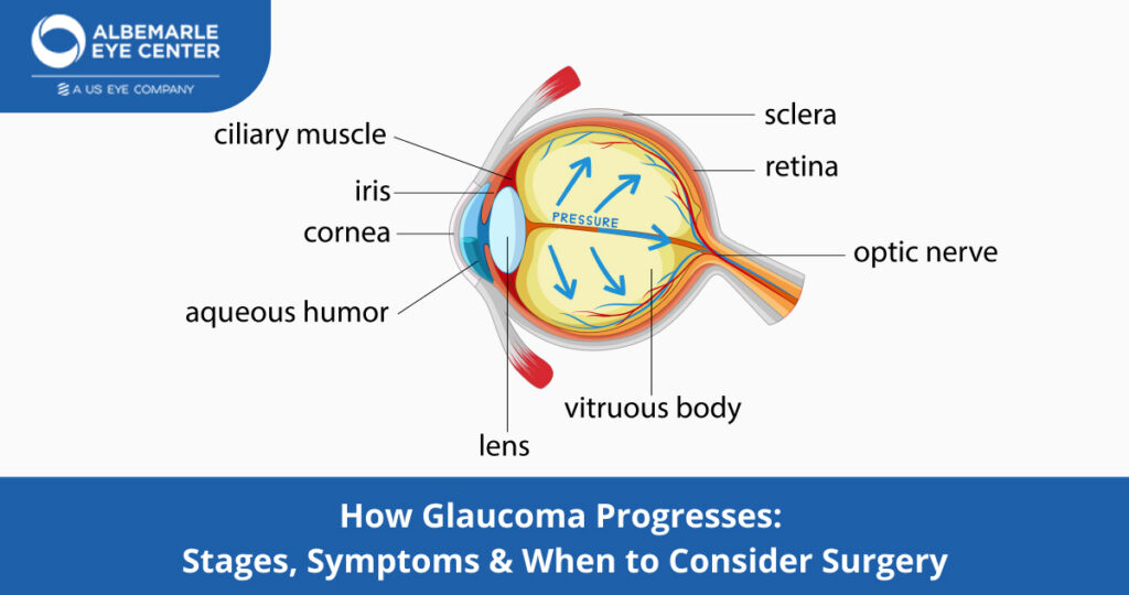How Glaucoma Progresses: Stages, Symptoms